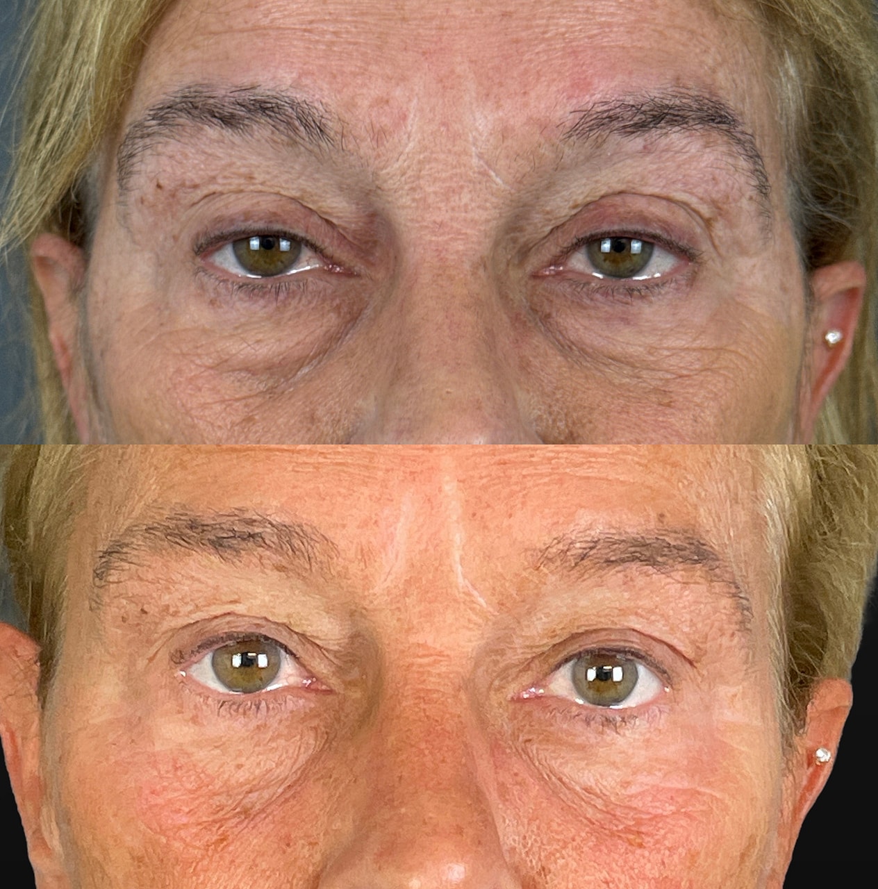 Ptosis Before & After