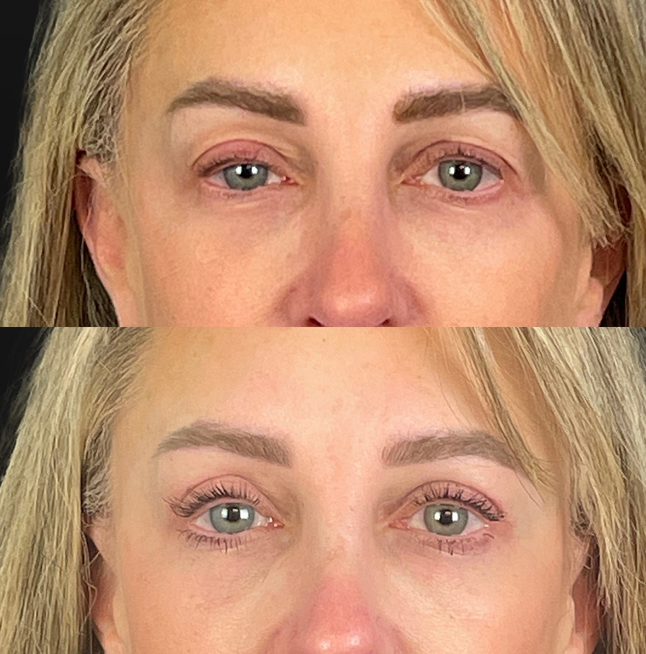Ptosis Before & After
