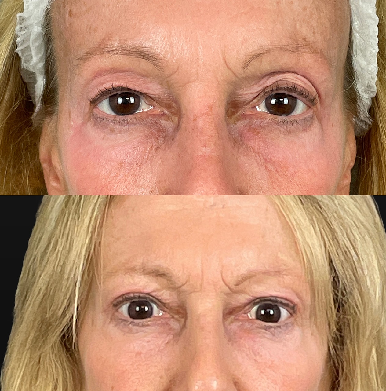 Ptosis Before & After
