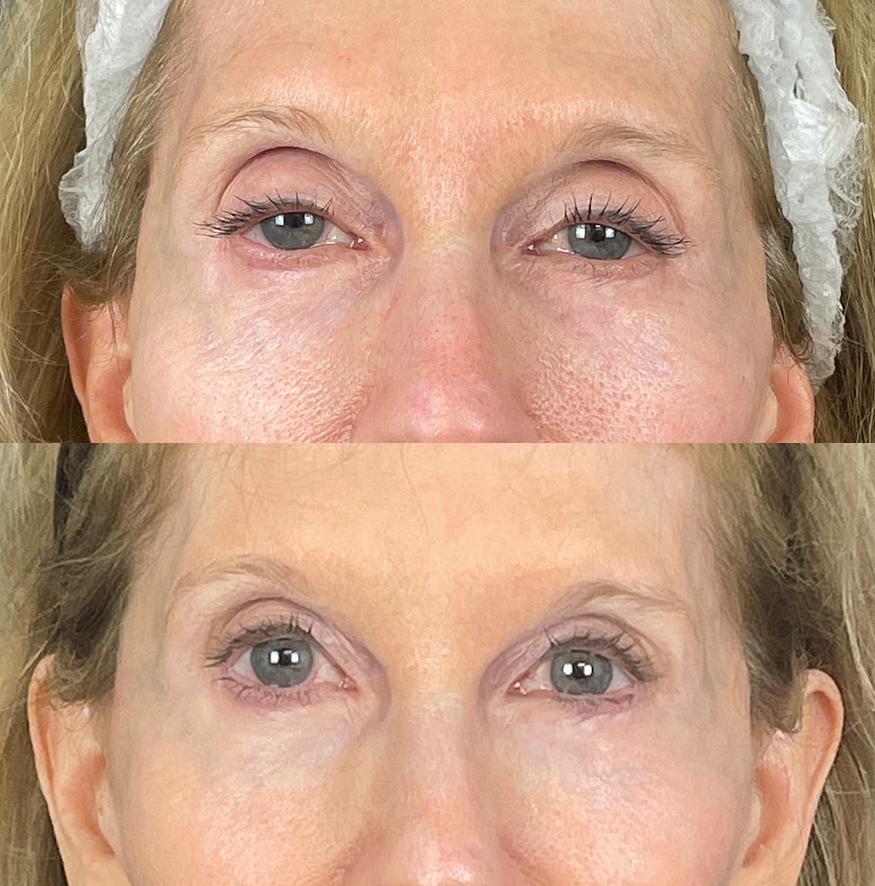 Ptosis Before & After