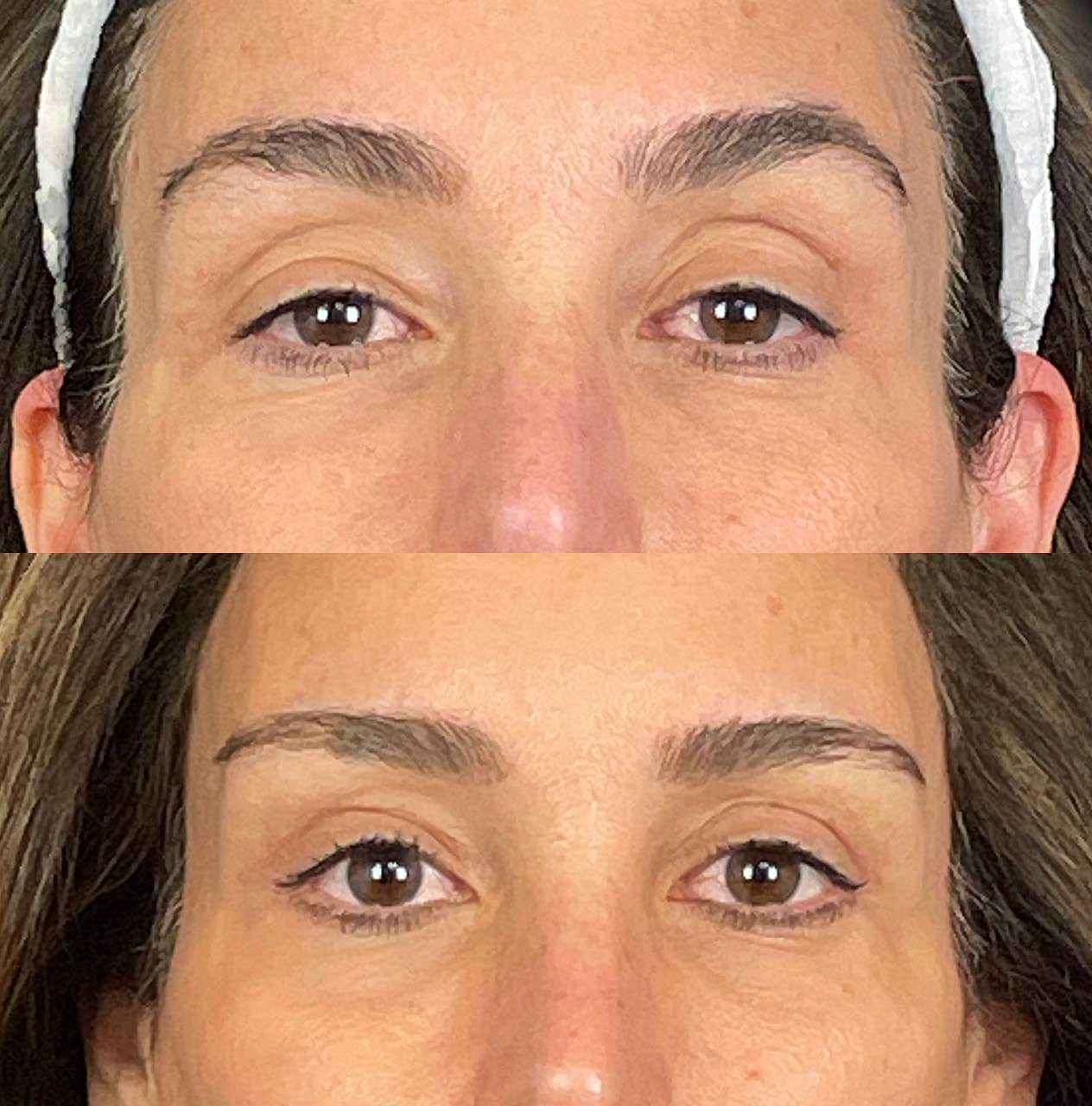 Ptosis Before & After