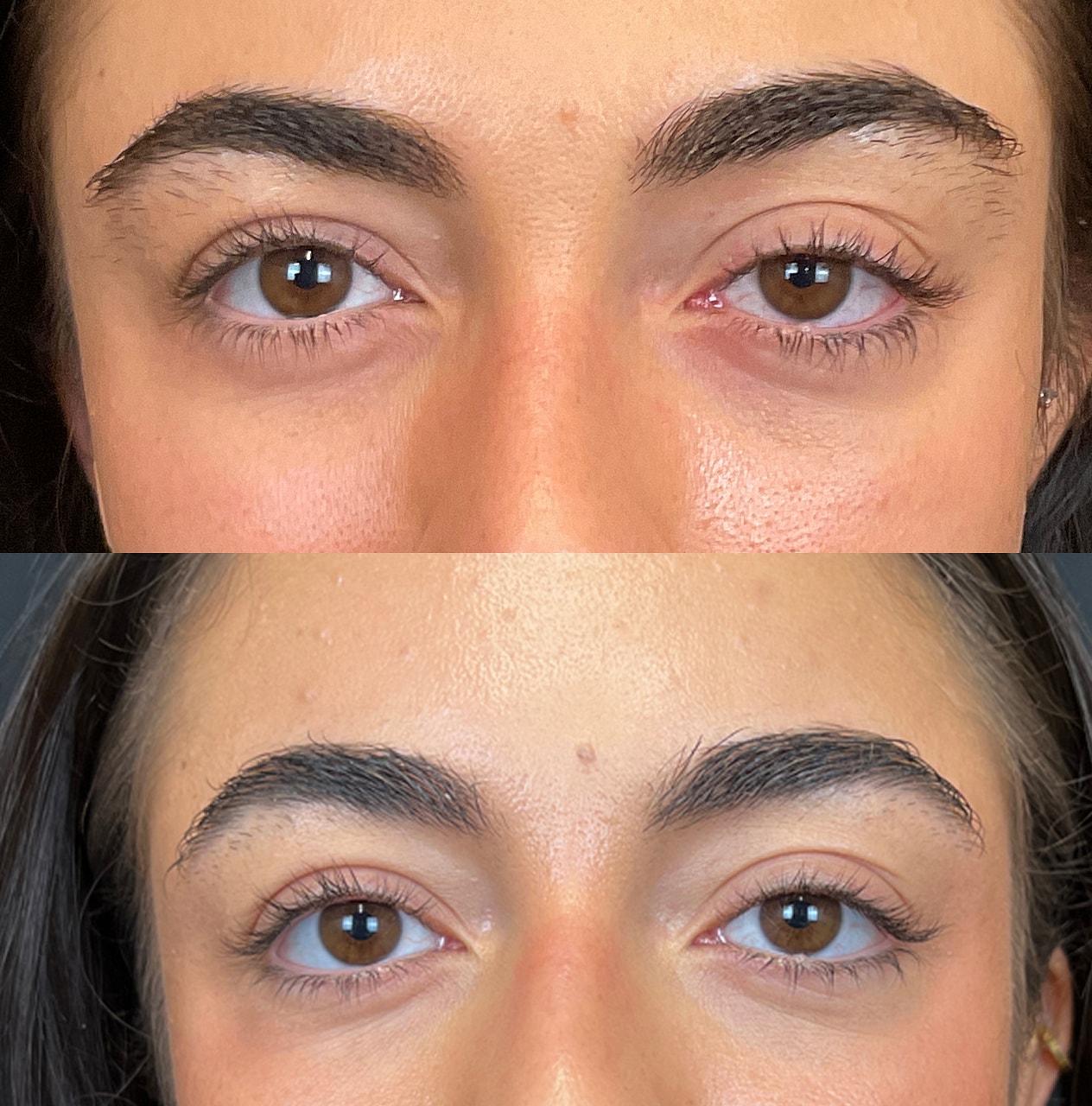 Ptosis Before & After
