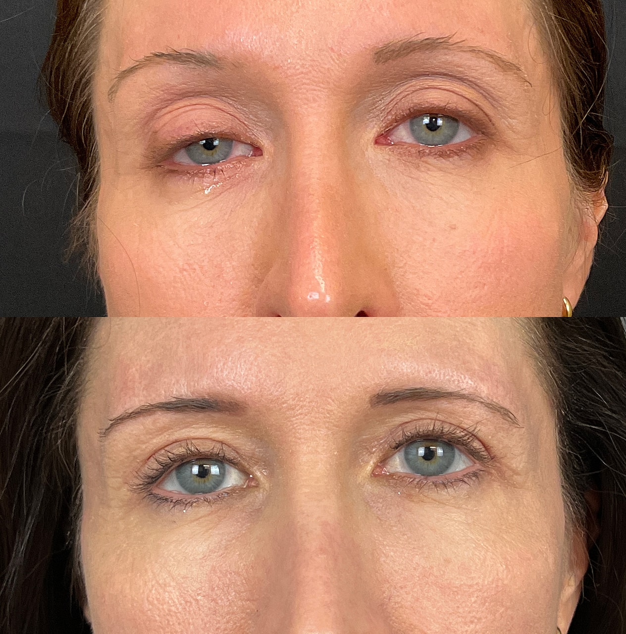 Ptosis Before & After