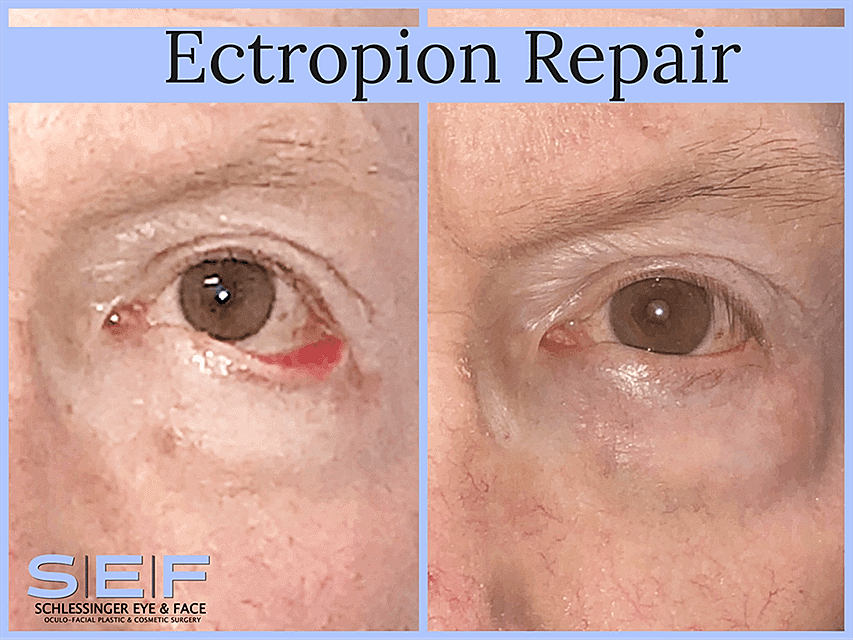 Ectropion repair before and after comparison.