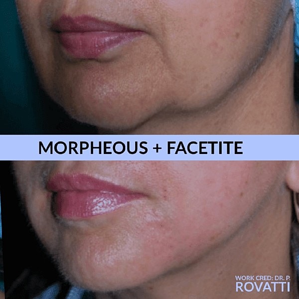 Morpheous and Facetite before and after