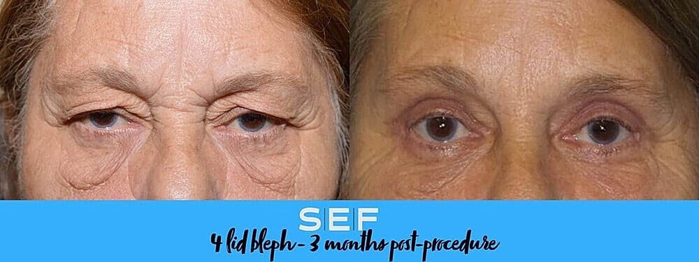 Schlessinger Eye & Face Testimonial