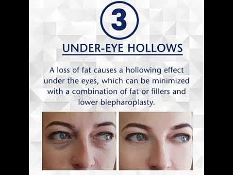 Under-eye hollows treatment options and effects.