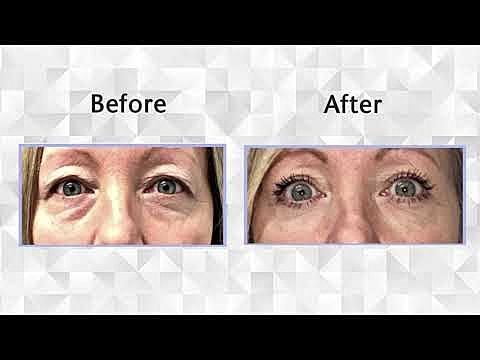 Eye appearance improvement before and after treatment