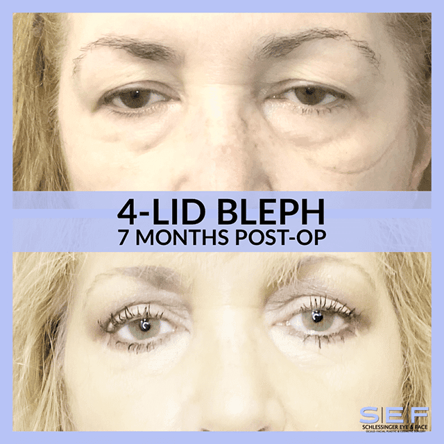 4 Lid Blepharoplasty Before and After