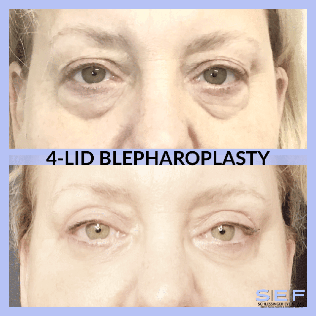 4 Lid Blepharoplasty Before and After