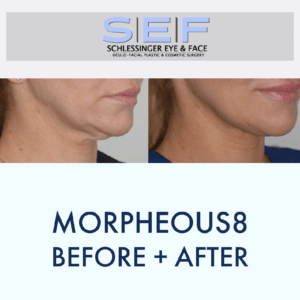 morpheous 8 before and after