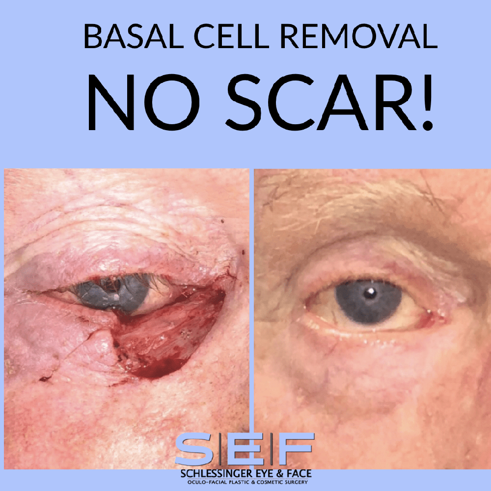Basal Cell Removal