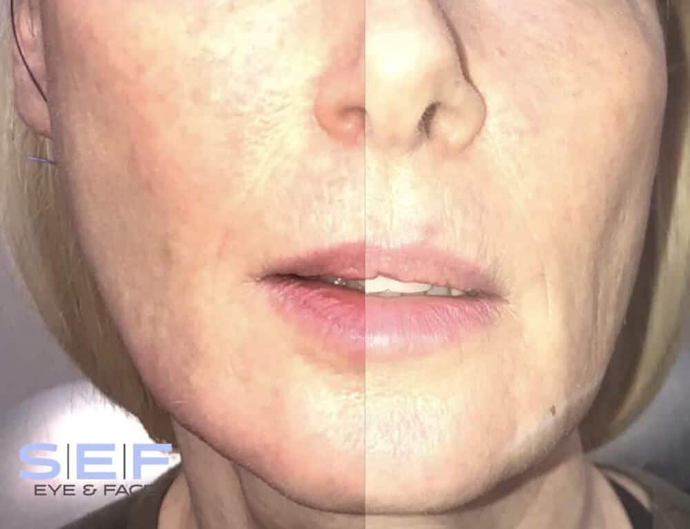 Thread Lift Long Island NovaThreads Woodbury Threading NY