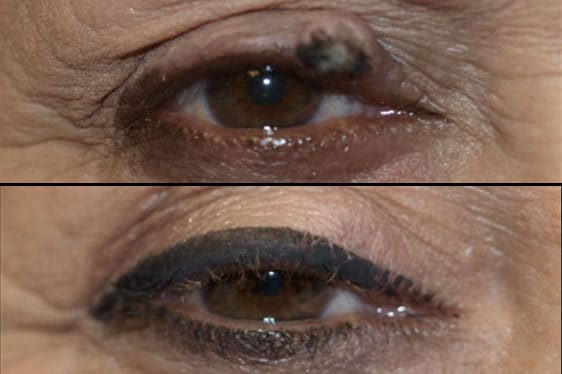 Eyelid Problems Before and After