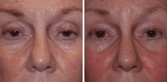 Ptosis Treatment Before and After