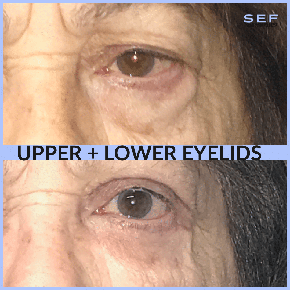 Lid Blepharoplasty Before and After