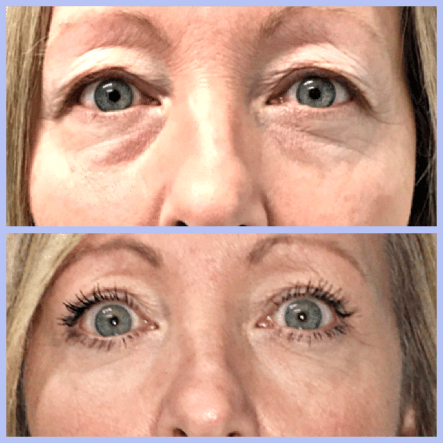 Blepharoplasty Before and After