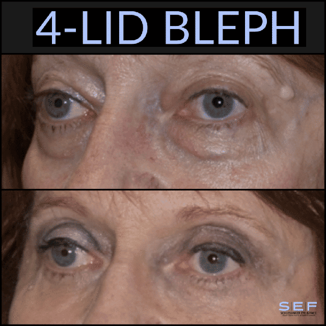 Blepharoplasty Before and After
