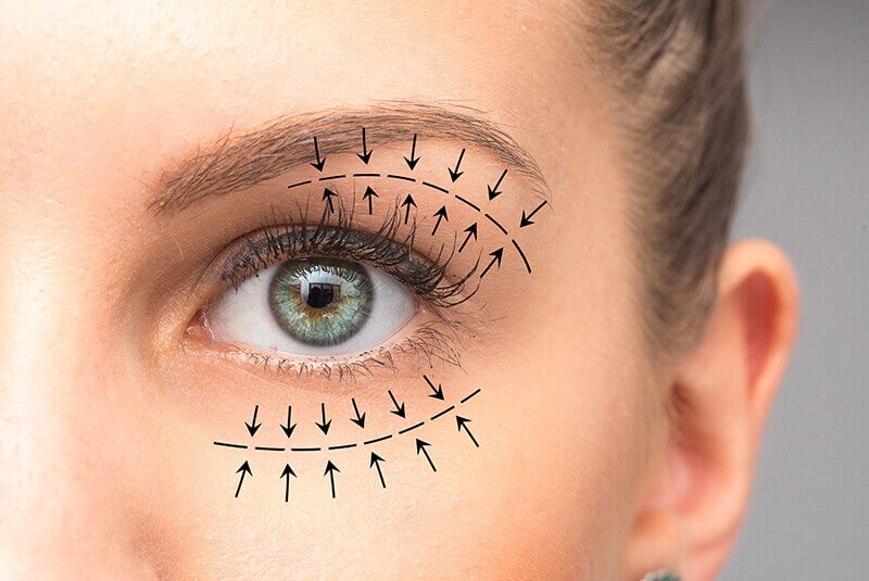 Woman's face ready for blepharoplasty surgery