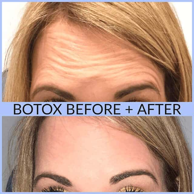 Botox before and after on forehead