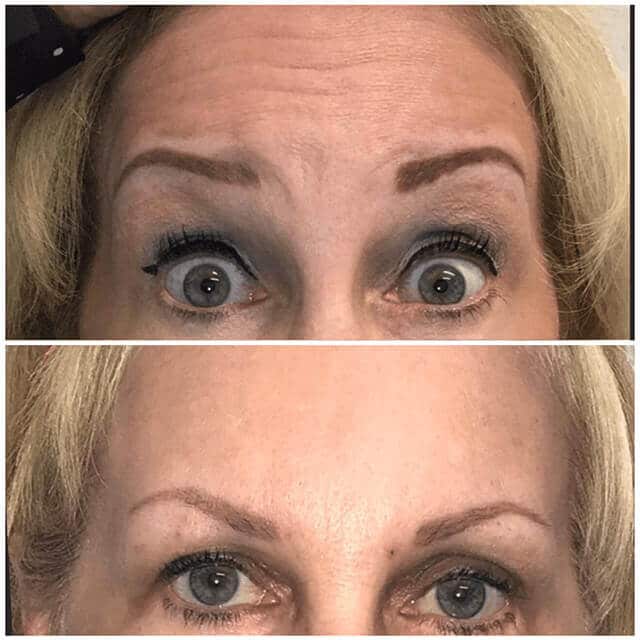 Botox before and after forehead and eyes
