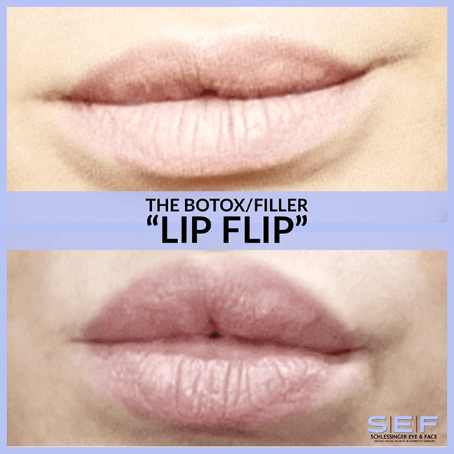Botox Lip Flip
