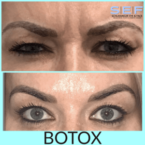 Botox Before and After