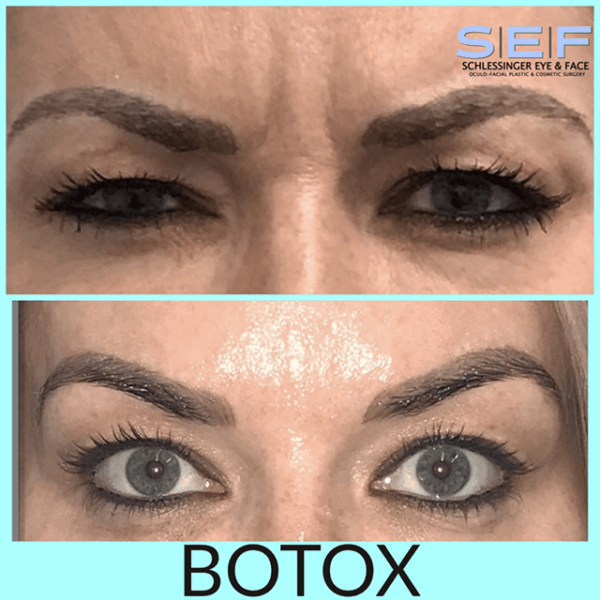 Botox Long Island Botox Before & After Schlessinger Eye