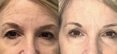 Browlift woman before and after
