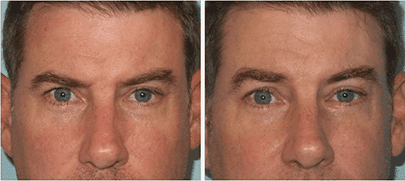 Browlift male before and after