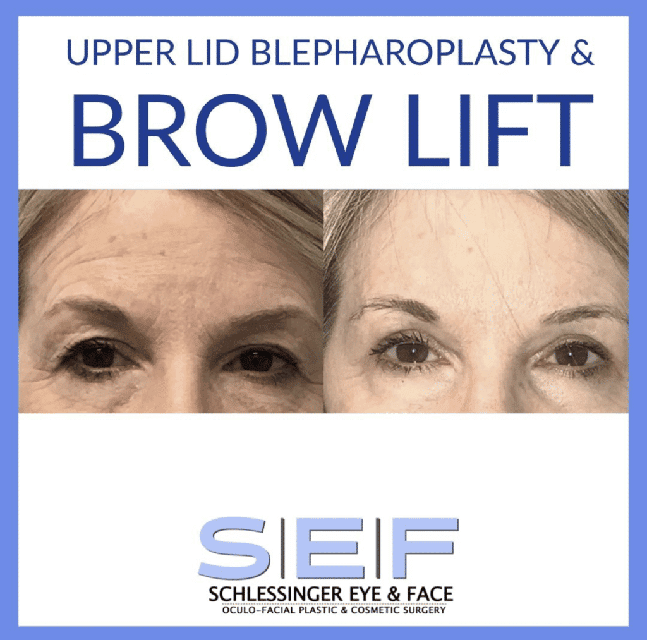 Browlift Before and After