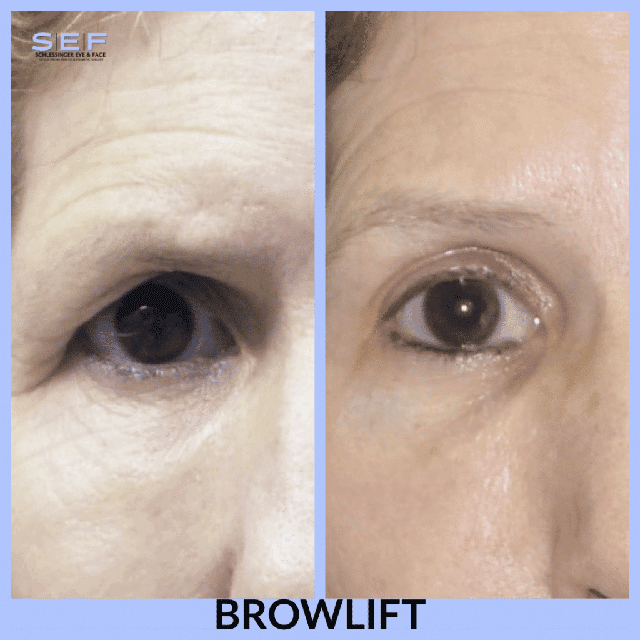 Browlift Before and After