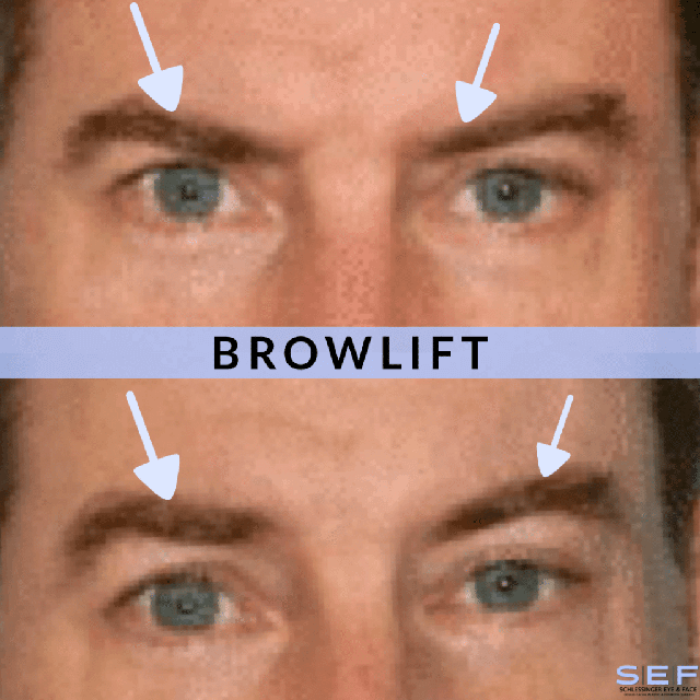 Browlift Before and After