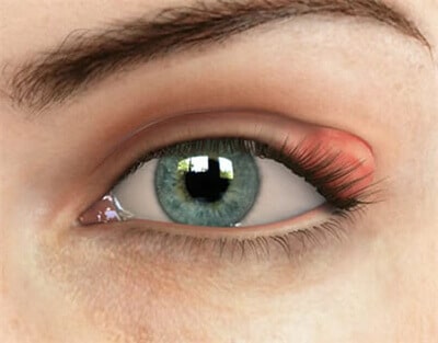 Close up chalazion on eye lid