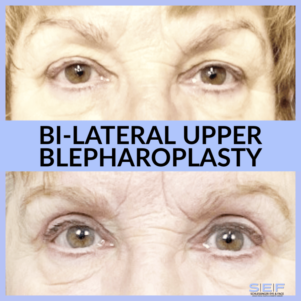 Before and After Upper Blepharoplasty