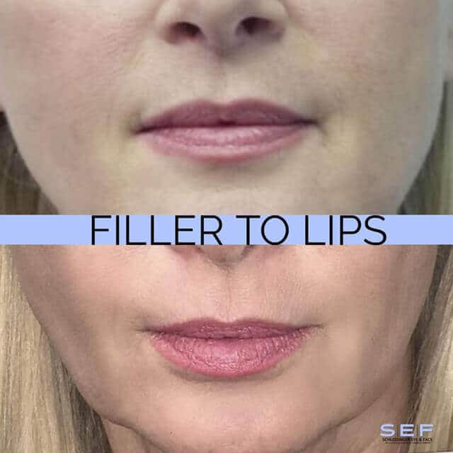 Dermal Fillers Before and After