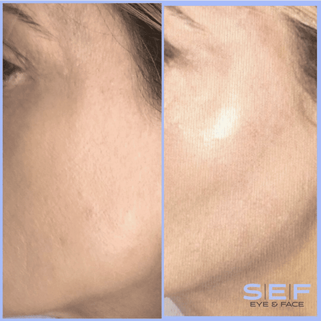 Radiesse Filler To Cheekbones Before and After