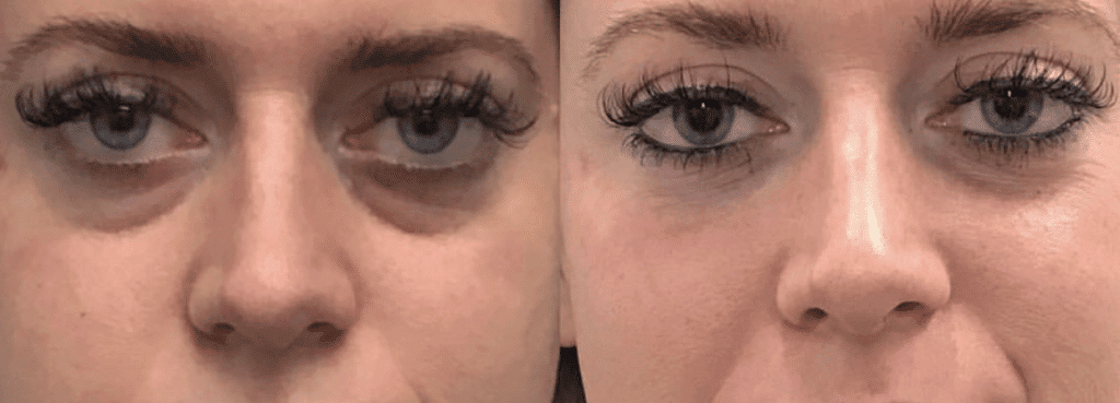 Restylane Injections Before and After