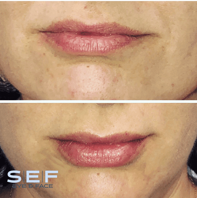 Lip Filler: Restylane Before and After