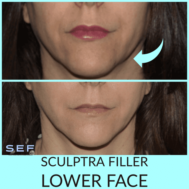 Sculptra Filler Before and After