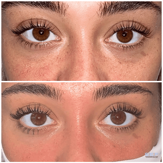Under Eye Filler Before and After