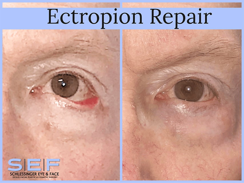 Ectropion Repair Before and After