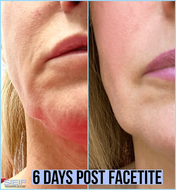 Facetite before and after
