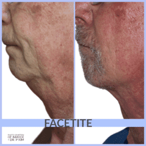 Facetite Before and After