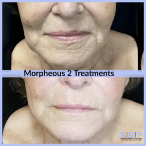 Morpheous 8 before and after 2 treatments