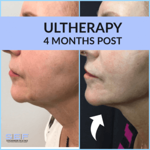 Ultherapy Before and After