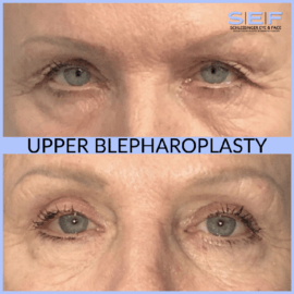 blepharoplasty before and after