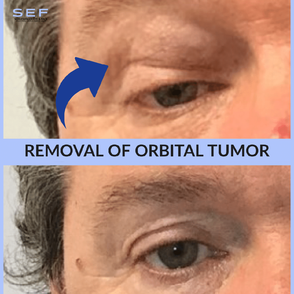 Orbital Tumor Removal Before and After
