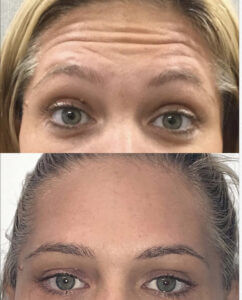 Botox before and after