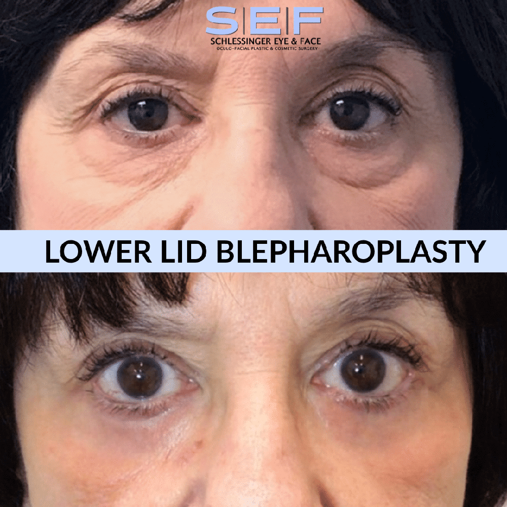 Lower Lid Blepharoplasty Before and After